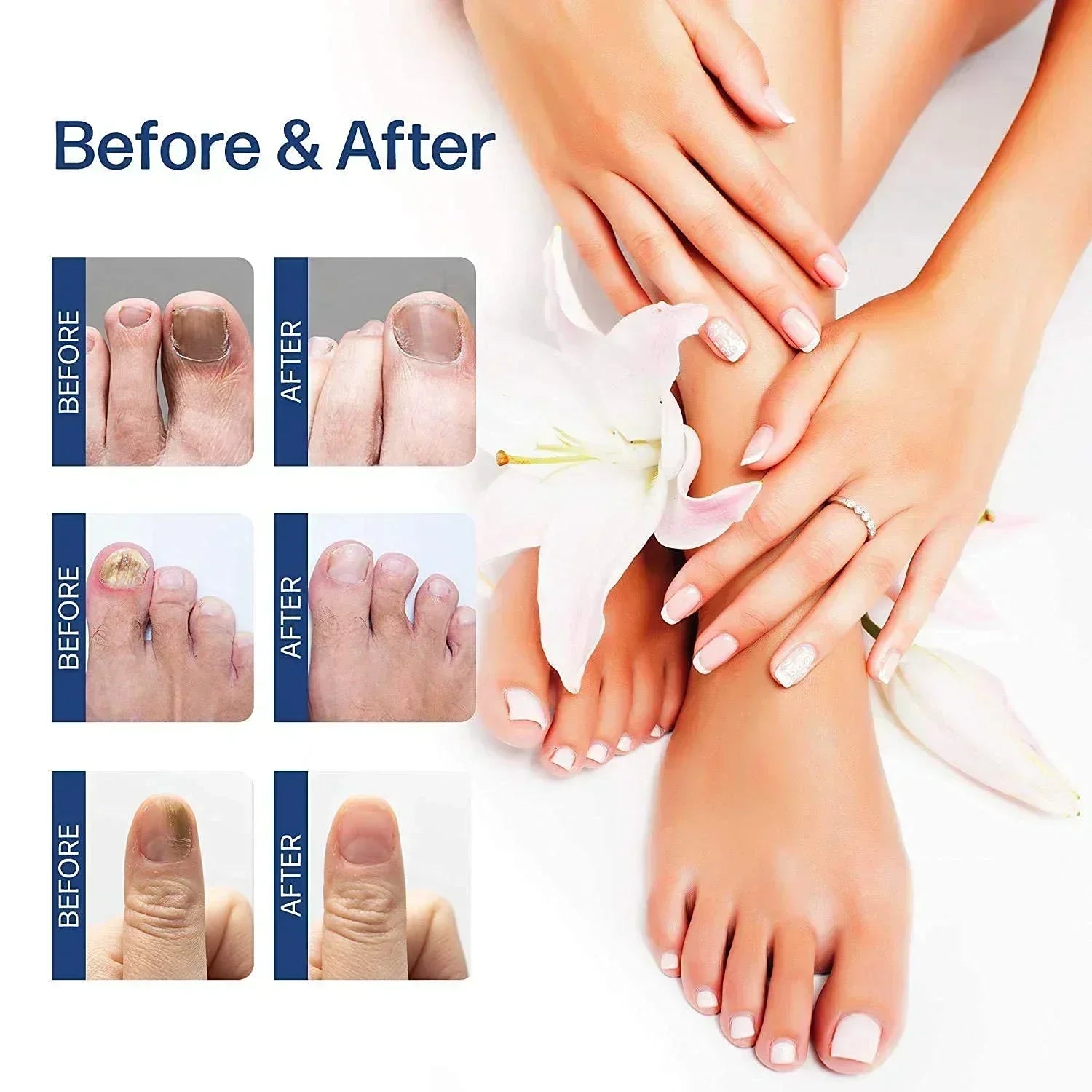 NailRenew™ Anti-Fungal Repair Oil 20ml