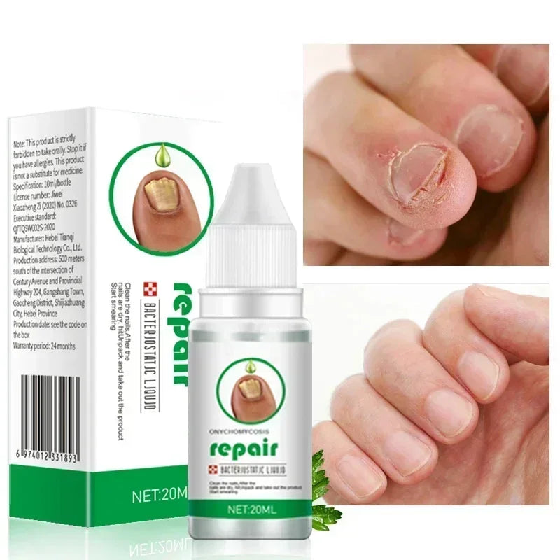 NailRenew™ Anti-Fungal Repair Oil 20ml